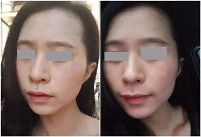 推淡斑专业榜单祛斑效果最好的第一AG真人游戏地址2024十大内